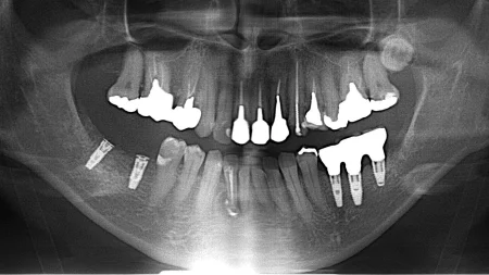 50代女性「インプラントを入れたい」右下の奥歯2本をインプラントで機能的にも審美的にも修復したケース | 市ヶ谷・歯医者