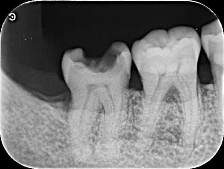50代男性「保険適用の詰め物が取れた。新しく作ってほしい」再発していた虫歯を取り切った後、ジルコニアで自然な白い見た目に回復した症例 | 市ヶ谷・歯医者