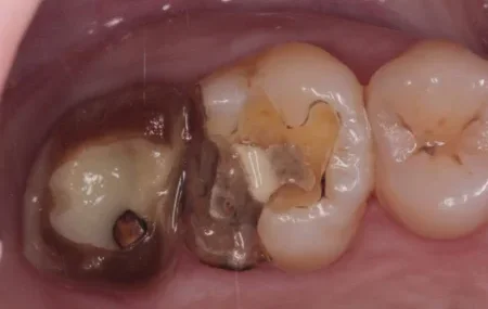 50代女性「金属アレルギーなので銀歯を別の素材できれいにしたい」ぴったりフィットしていなかった保険の銀の詰め物をメタルフリーのジルコニアできれいに修復した症例 | 市ヶ谷・歯医者