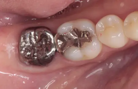 30代女性「歯ぐきが腫れていて、噛むと痛い」歯の根っこの治療後に隙間から細菌が入り歯根膜炎を発症。根管治療をMTAセメントでやり直し、新たにチタンの被せ物を作り直した症例 | 市ヶ谷・歯医者