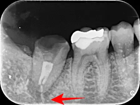 30代女性「歯ぐきが腫れていて、噛むと痛い」歯の根っこの治療後に隙間から細菌が入り歯根膜炎を発症。根管治療をMTAセメントでやり直し、新たにチタンの被せ物を作り直した症例 | 市ヶ谷・歯医者