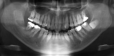 40代男性「歯肉が腫れて噛むと痛い」歯周ポケットが深く状態が悪い奥歯と埋まっていた親知らずを抜き、親知らずを移植して歯周病を改善した症例 | 市ヶ谷・歯医者