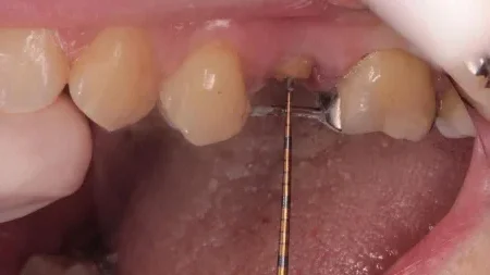 30代女性「差し歯が繰り返し取れる」被せ物をしっかり固定できるよう歯を引き上げて接着面を確保し、セラミックで原状回復した症例 | 市ヶ谷・歯医者
