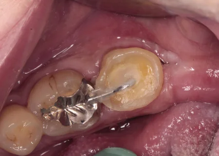 40代男性「歯肉が腫れて噛むと痛い」歯周ポケットが深く状態が悪い奥歯と埋まっていた親知らずを抜き、親知らずを移植して歯周病を改善した症例 | 市ヶ谷・歯医者