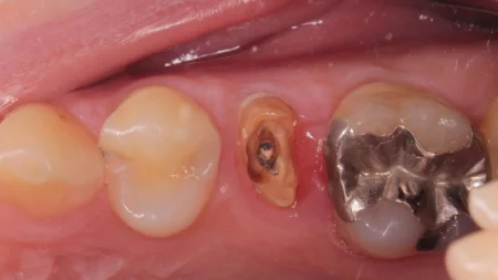 30代女性「差し歯が繰り返し取れる」被せ物をしっかり固定できるよう歯を引き上げて接着面を確保し、セラミックで原状回復した症例 | 市ヶ谷・歯医者