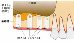 歯槽骨の薄い部分の上顎洞底部に骨移植や骨補填材を填入します | 市ヶ谷・歯医者