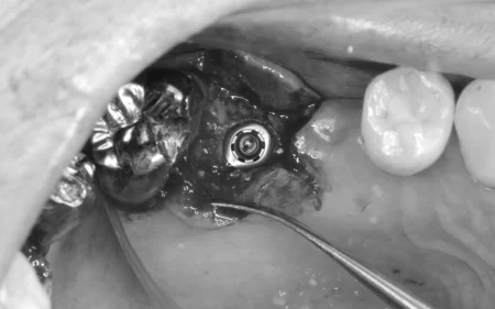 60代男性「ブリッジがぐらぐらして噛めない」虫歯を抜歯し、骨を増やしてからインプラントを埋め込んで新たにブリッジを作り直した症例 | 市ヶ谷・歯医者