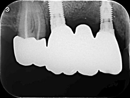 60代男性「ブリッジがぐらぐらして噛めない」虫歯を抜歯し、骨を増やしてからインプラントを埋め込んで新たにブリッジを作り直した症例 | 市ヶ谷・歯医者