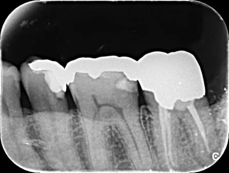 50代男性「数年前に治療した歯がズキズキ痛む」歯の内側から広がった虫歯と根っこの炎症を、殺菌作用が高く神経の穴をぴったり埋めるセメント「MTA」を使用して治癒させた症例 | 市ヶ谷・歯医者