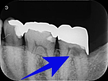 50代男性「数年前に治療した歯がズキズキ痛む」歯の内側から広がった虫歯と根っこの炎症を、殺菌作用が高く神経の穴をぴったり埋めるセメント「MTA」を使用して治癒させた症例 | 市ヶ谷・歯医者
