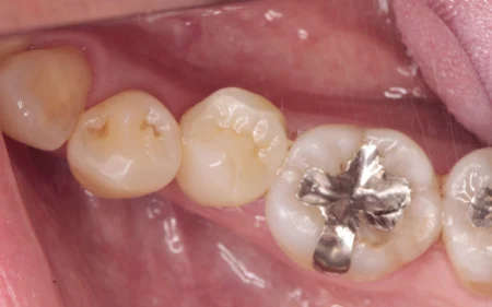 50代女性「銀歯をきれいに治したい」歯に合わなくなった銀の詰め物を除去し、自然な白さで強度もある「ジルコニア」で審美的に修復したケース | 市ヶ谷・歯医者