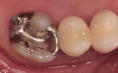 50代女性「銀歯をきれいに治したい」歯に合わなくなった銀の詰め物を除去し、自然な白さで強度もある「ジルコニア」で審美的に修復したケース | 市ヶ谷・歯医者