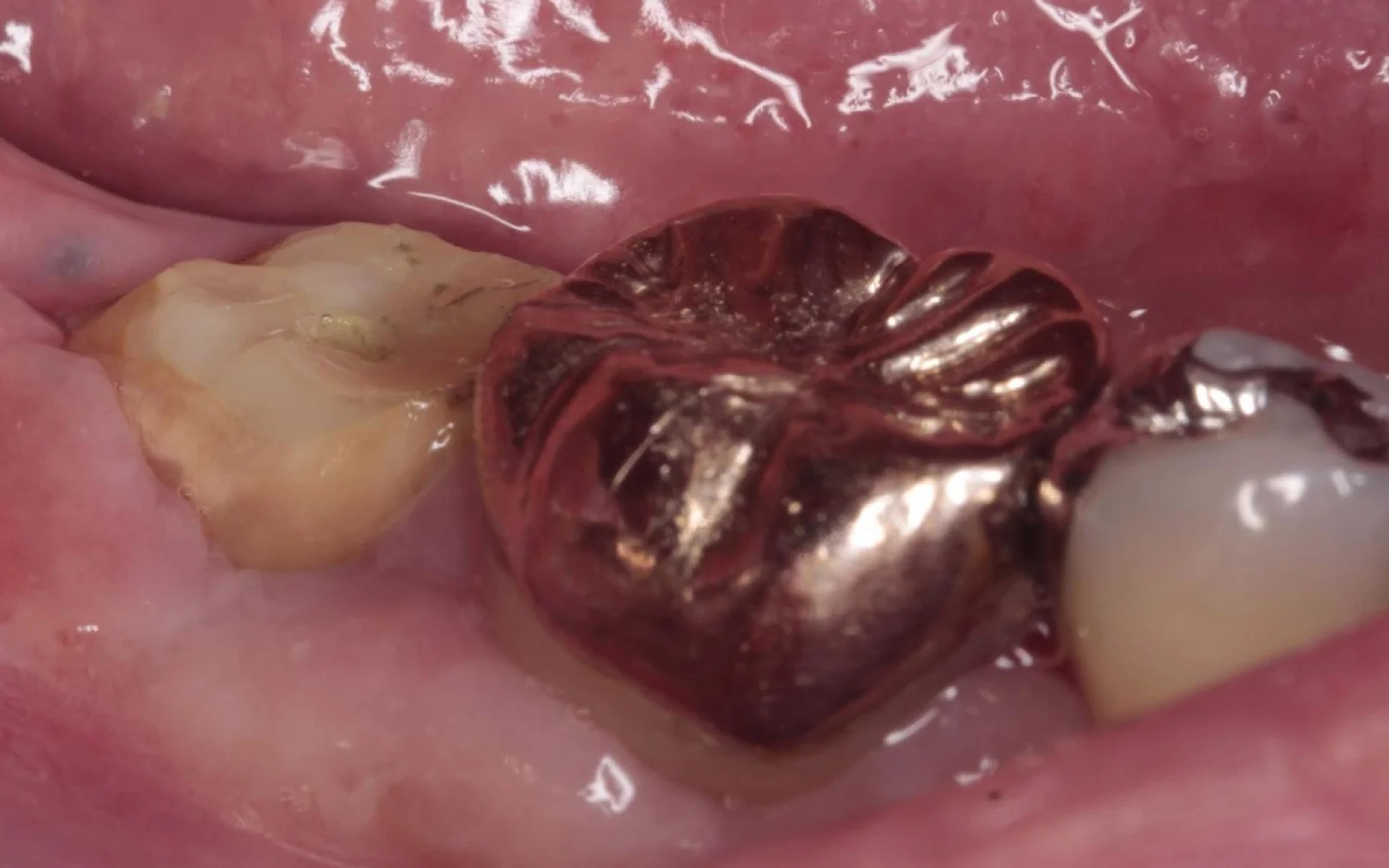 50代女性「歯ぐきが頻繁に腫れて噛むと痛む」歯周病で溶けてしまった歯の根っこを支える骨に再生療法と歯ぐきの移植を行い、新たな被せ物で治療した症例 | 市ヶ谷・歯医者