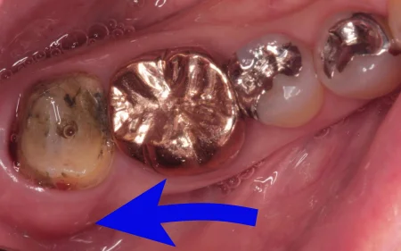 50代女性「歯ぐきが頻繁に腫れて噛むと痛む」歯周病で溶けてしまった歯の根っこを支える骨に再生療法と歯ぐきの移植を行い、新たな被せ物で治療した症例 | 市ヶ谷・歯医者
