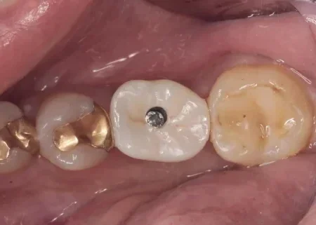 40代女性「左下の奥歯で噛むと違和感がある」根の治療で炎症が改善されなかった歯を抜き、インプラントを埋め込んでしっかり噛めるようになった症例 | 市ヶ谷・歯医者