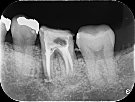 40代女性「左下の奥歯で噛むと違和感がある」根の治療で炎症が改善されなかった歯を抜き、インプラントを埋め込んでしっかり噛めるようになった症例 | 市ヶ谷・歯医者