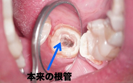 治療中 | 市ヶ谷・歯医者