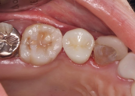 治療後 | 市ヶ谷・歯医者