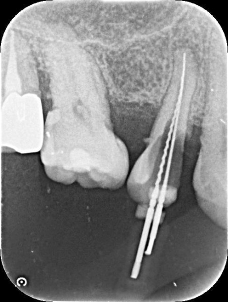 治療中 | 市ヶ谷・歯医者