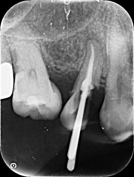 治療中 | 市ヶ谷・歯医者