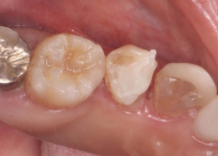 治療中 | 市ヶ谷・歯医者