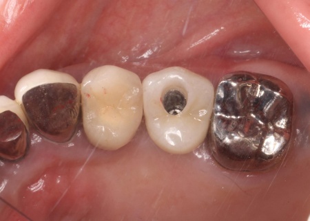 治療後 | 市ヶ谷・歯医者