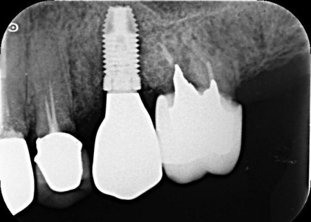 治療後 | 市ヶ谷・歯医者