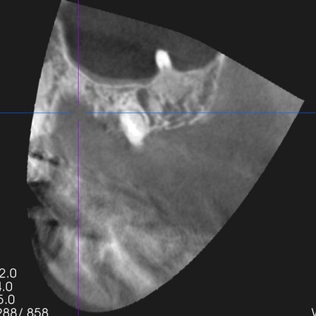 治療前 | 市ヶ谷・歯医者