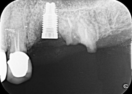 治療中 | 市ヶ谷・歯医者
