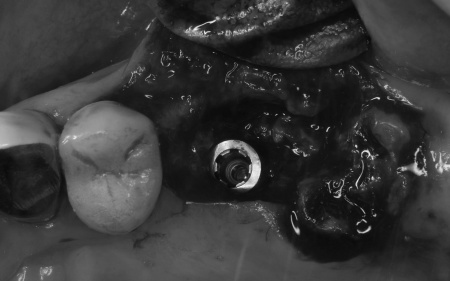 治療中 | 市ヶ谷・歯医者