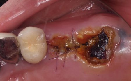 治療中 | 市ヶ谷・歯医者