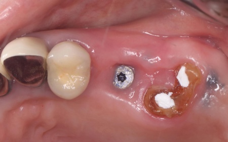 治療中 | 市ヶ谷・歯医者