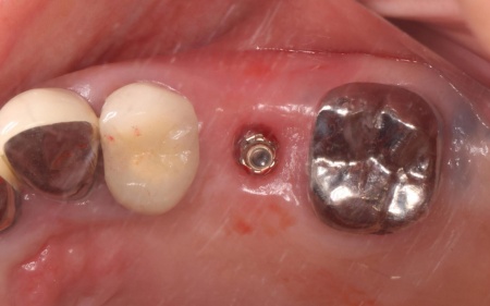 治療中 | 市ヶ谷・歯医者