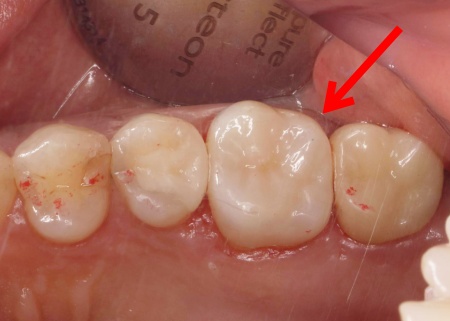 治療後 | 市ヶ谷・歯医者