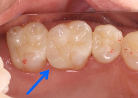 治療後 | 市ヶ谷・歯医者