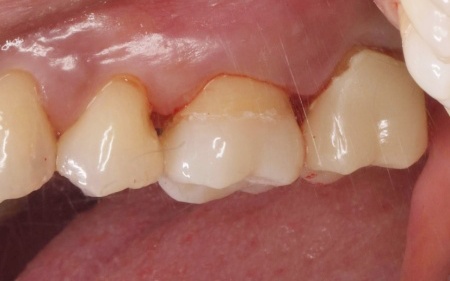 治療後 | 市ヶ谷・歯医者