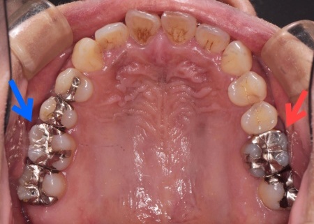 治療前 | 市ヶ谷・歯医者