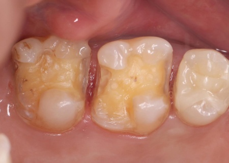 治療中 | 市ヶ谷・歯医者
