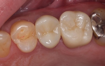 治療後 | 市ヶ谷・歯医者