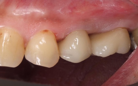 治療後 | 市ヶ谷・歯医者