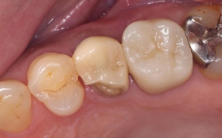 治療前 | 市ヶ谷・歯医者