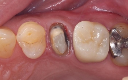 治療中 | 市ヶ谷・歯医者