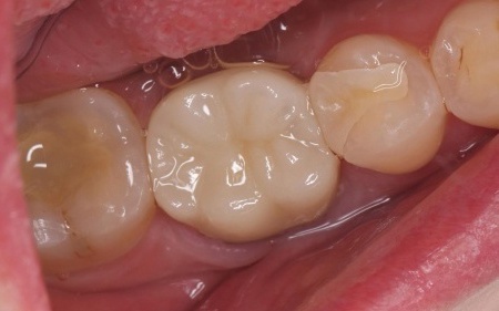 治療後 | 市ヶ谷・歯医者