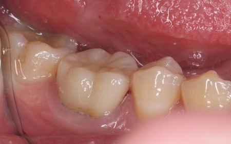 治療後 | 市ヶ谷・歯医者