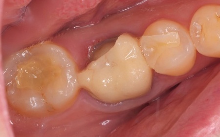 治療前 | 市ヶ谷・歯医者