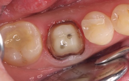 治療中 | 市ヶ谷・歯医者