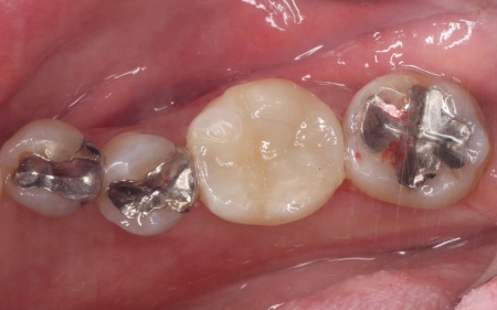 治療後 | 市ヶ谷・歯医者