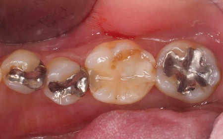 治療前 | 市ヶ谷・歯医者