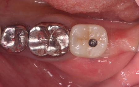 治療後 | 市ヶ谷・歯医者