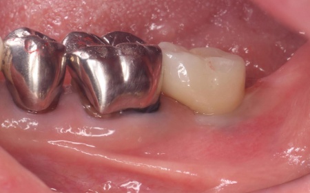 治療後 | 市ヶ谷・歯医者